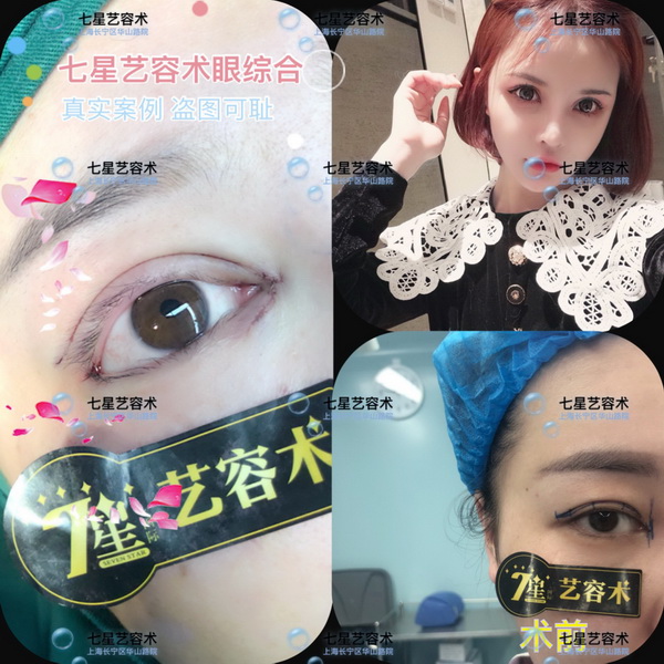 上海**网红整形|上海肋骨隆鼻整形