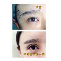 乐山鼻综合整形@乐山自体脂肪整形