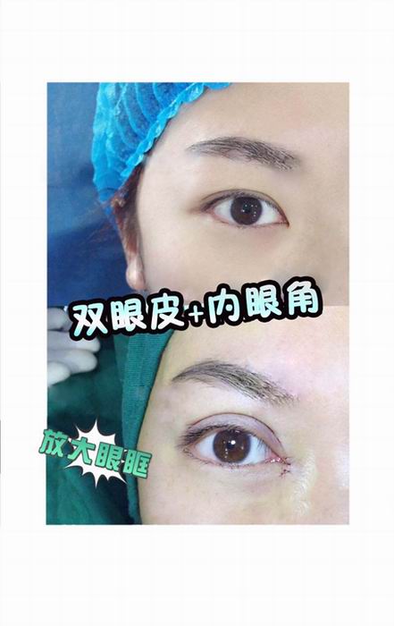 乐山鼻综合整形@乐山自体脂肪整形