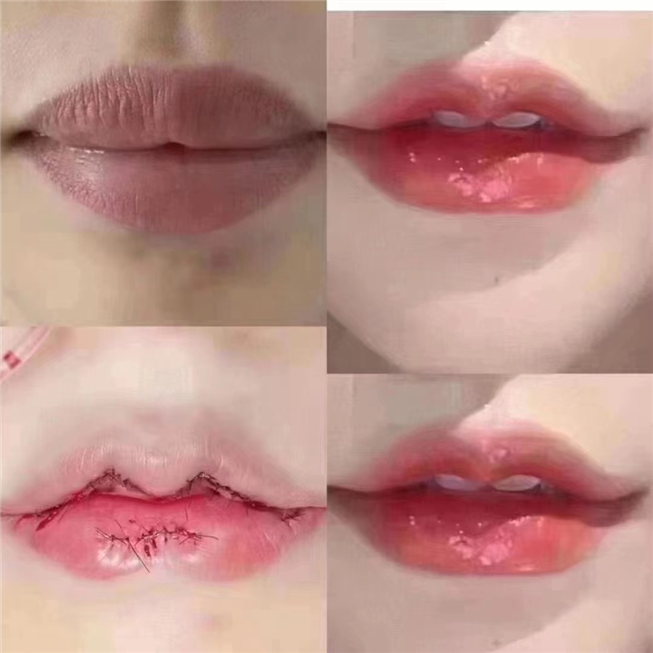 上海微加医疗美容M唇整形