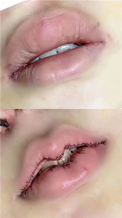 上海微加医疗唇综合案例