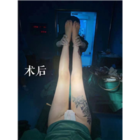 上海微加大腿环吸精雕案例