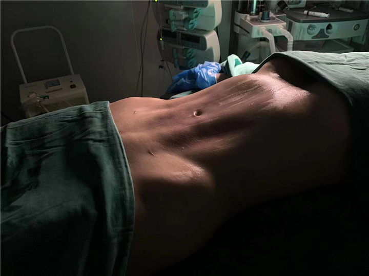 上海微加腰腹环吸精雕案例对比