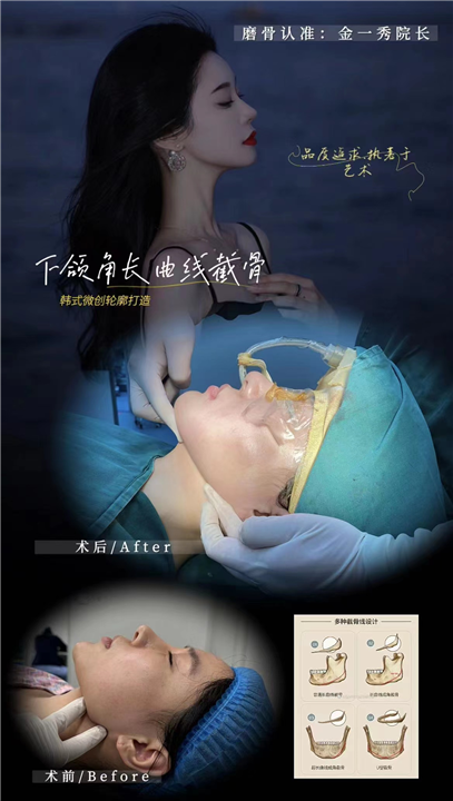 上海磨骨认准金一秀院长