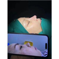 上海微加肋骨鼻整形