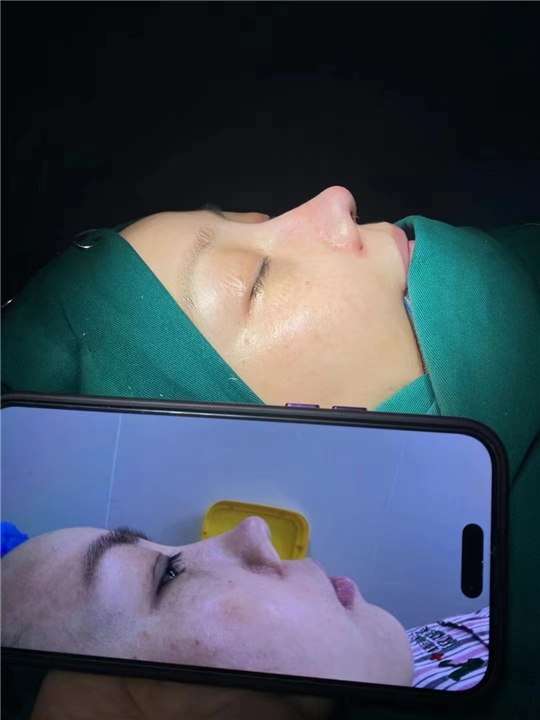 上海微加肋骨鼻整形
