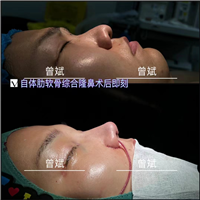 郑州鼻整形医生