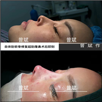 郑州鼻整形医生曾斌