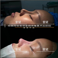 曾斌膨体隆鼻VS硅胶隆鼻，哪种隆鼻方式更适合你？