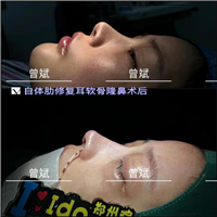 曾斌隆鼻