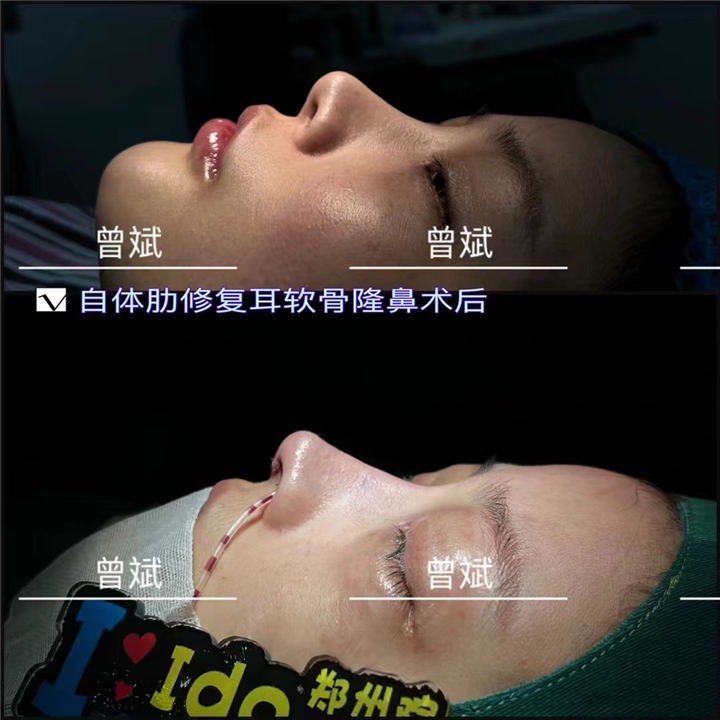曾斌隆鼻