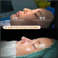 郑州鼻整形曾斌