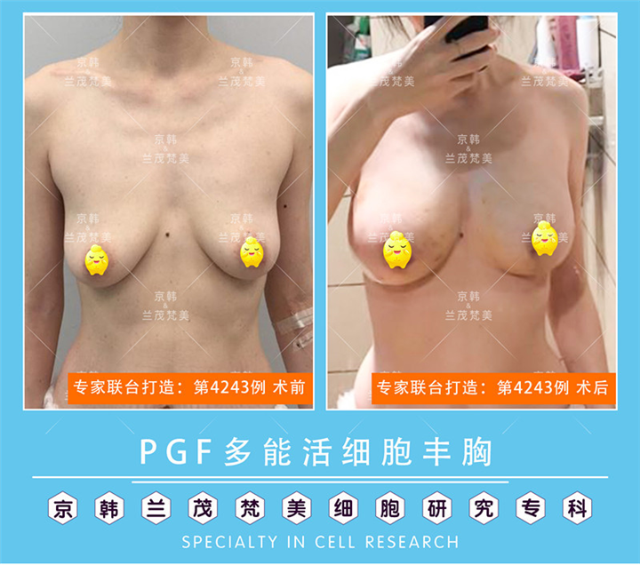 北京乔爱军脂肪隆胸专家 