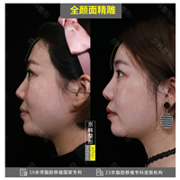 北京脂肪填充面部哪里好 