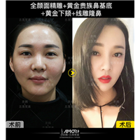 北京面部脂肪填充
