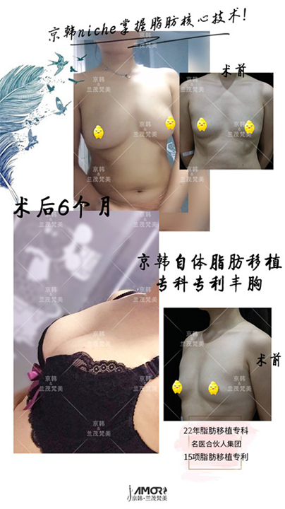 乔爱军做脂肪隆胸多少钱 