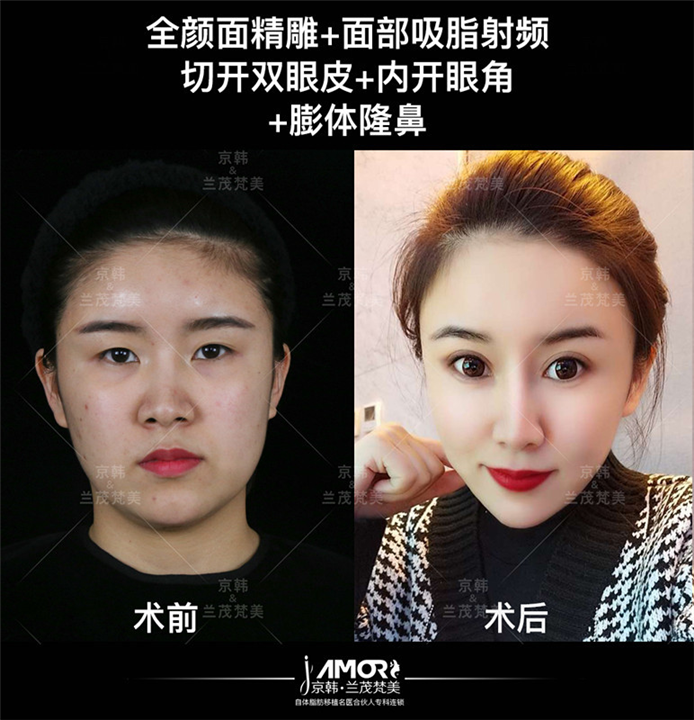 北京自体脂肪填充专家 