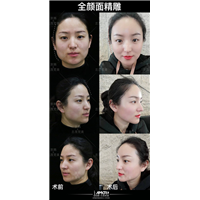 自体脂肪填充过多怎么办