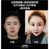北京自体脂肪填充专家 