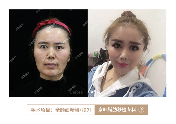 北京乔爱军脸部脂肪填充案例 