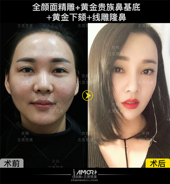 北京面部脂肪填充 