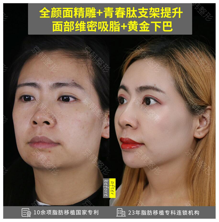 北京做面部脂肪填充多少钱 