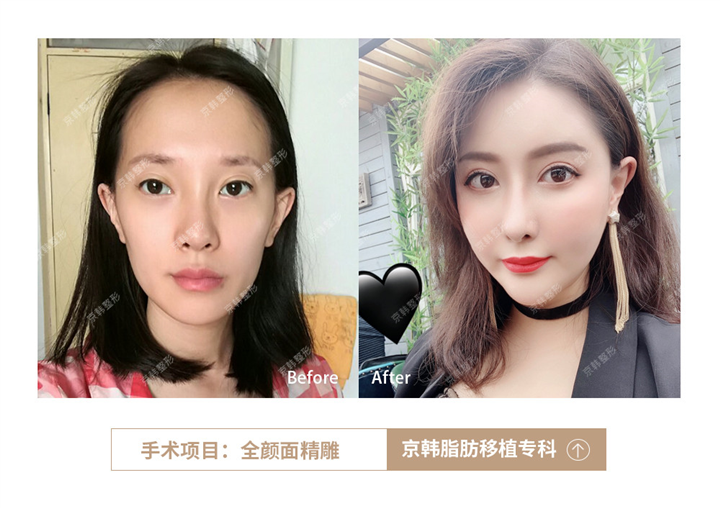 北京做脂肪填充有名的医生 