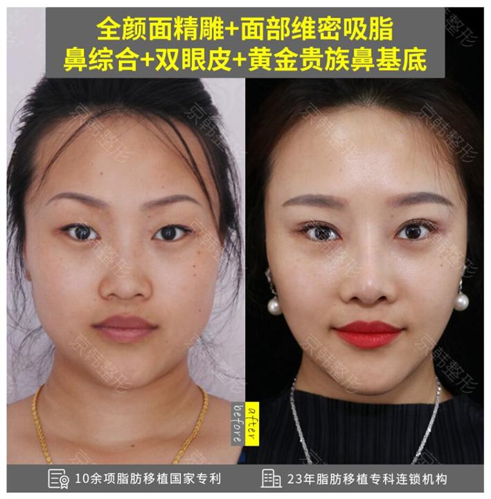 自体脂肪面部填充维持多久 