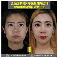 北京做脂肪填充哪家好 