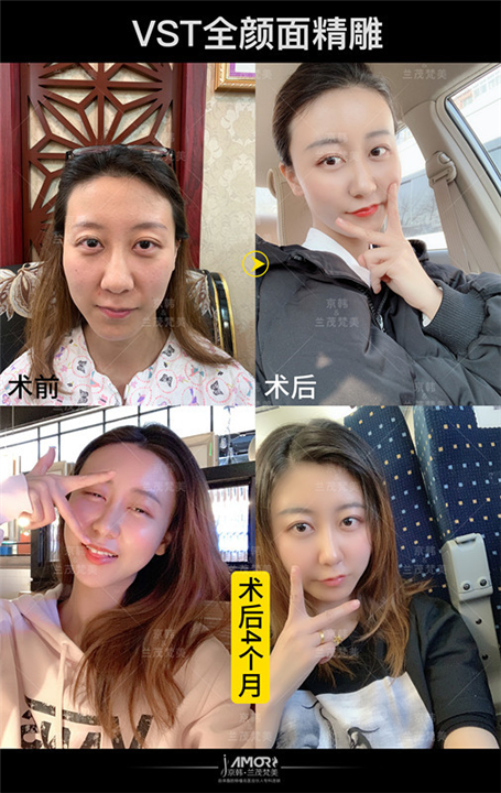 北京做脂肪填充有名的医生 