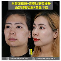 北京做面部脂肪填充多少钱 