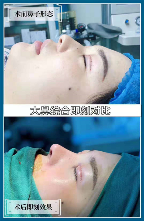 上海大鼻综合术后即刻对比