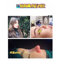 上海鼻整形修复 