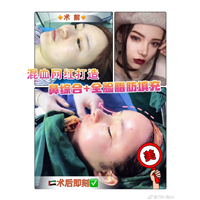 上海自体脂肪填充整形