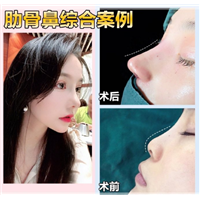 上海鼻综合整形修复