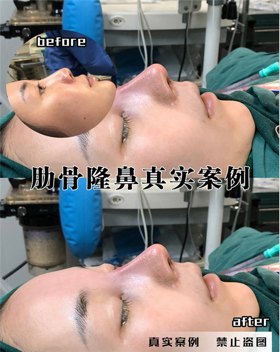上海肋骨隆鼻