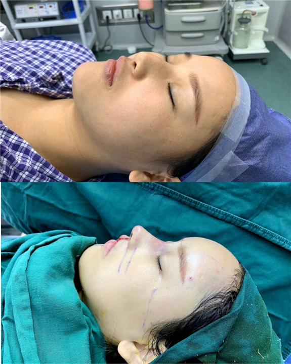 上海做鼻综合整形大概多少钱