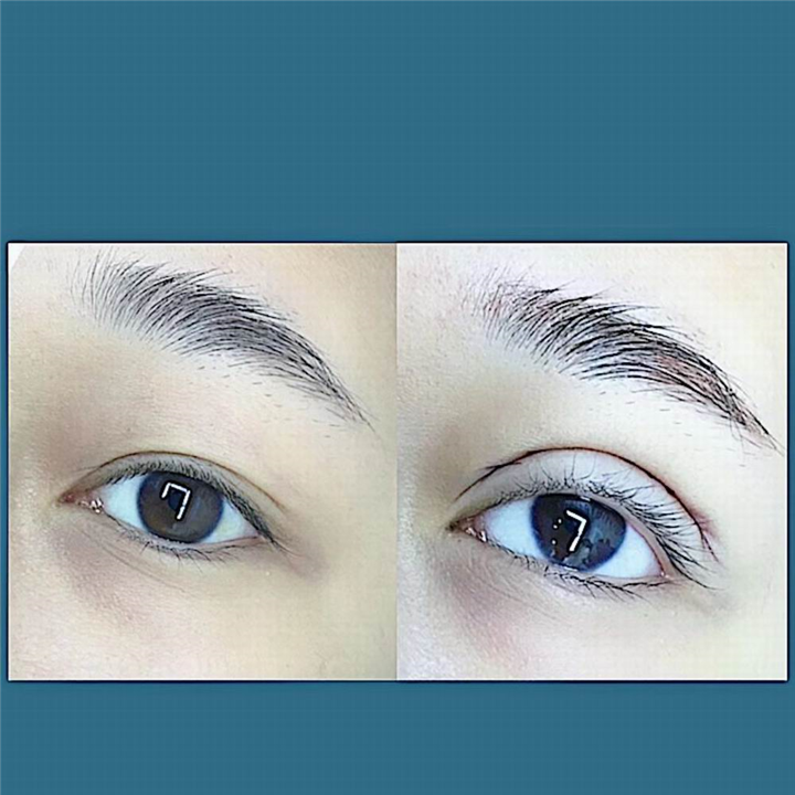 上海眼综合整形案例