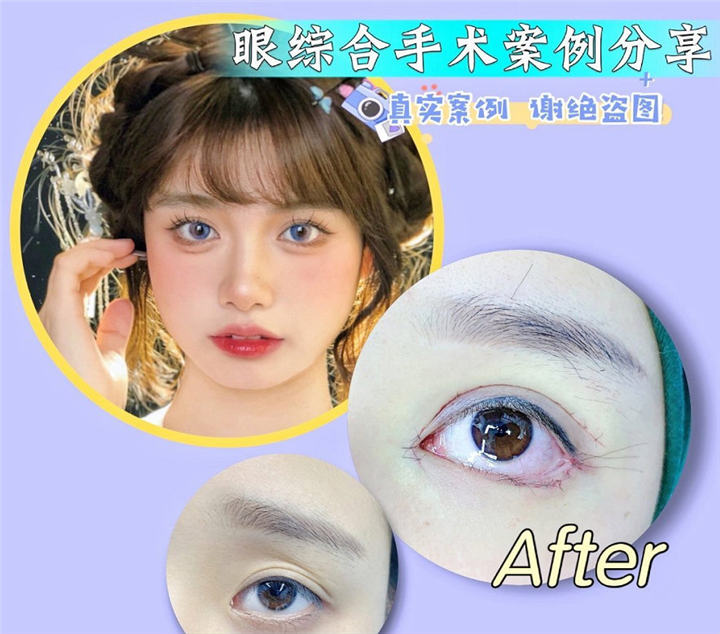 上海眼综合手术