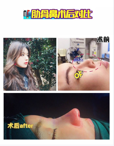 上海鼻整形修复 