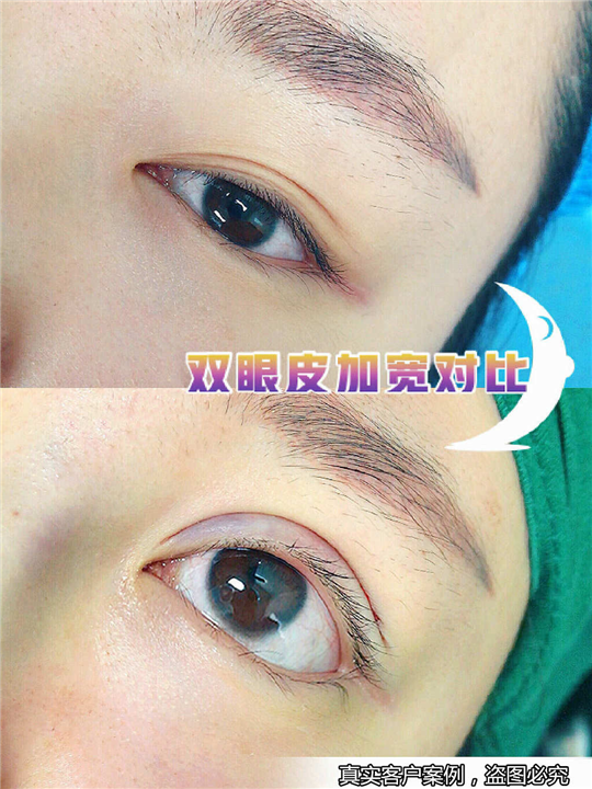 上海割双眼皮整形 