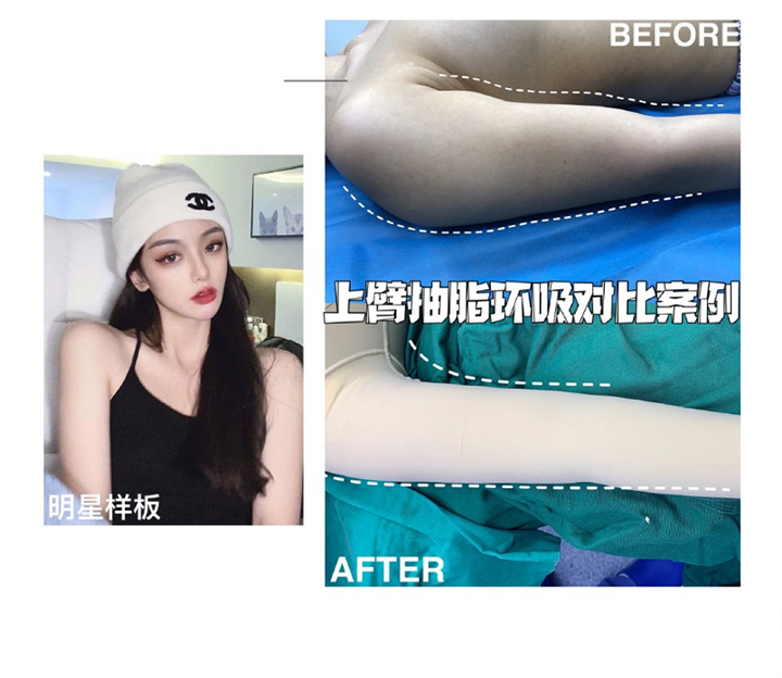 上海手臂吸脂整形