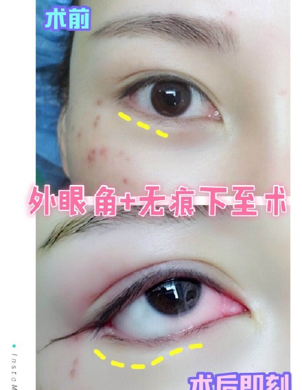 上海眼睛整形