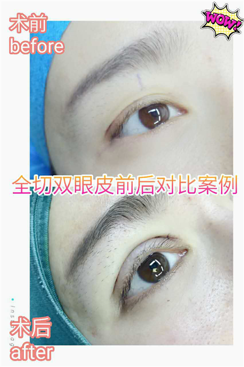 上海双眼皮整形