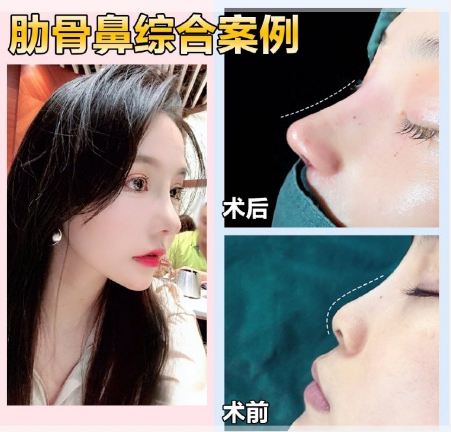 上海鼻综合整形修复