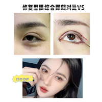 上海割双眼皮多少钱