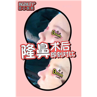 王武松医生隆鼻案例
