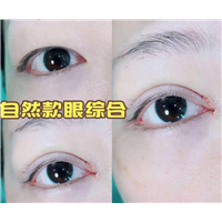 上海自然款眼综合整形