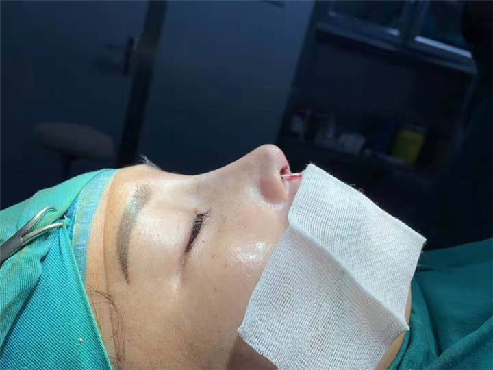 重庆肋软骨隆鼻修复