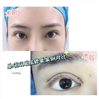 重庆双眼皮修复 